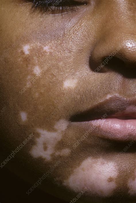 Vitiligo Skin Patches Stock Image C0465340 Science Photo Library