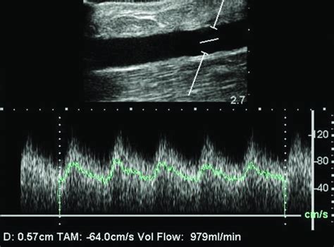 Doppler Ultrasound Evaluation Of Avf Ow Doppler Ultrasound May Be