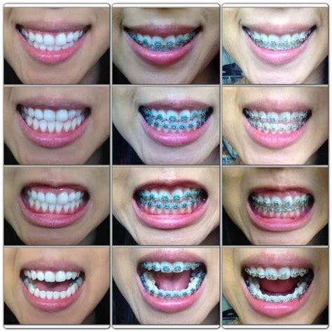 What Color Braces Bands Make Teeth Look Whiter Shenika Beyer