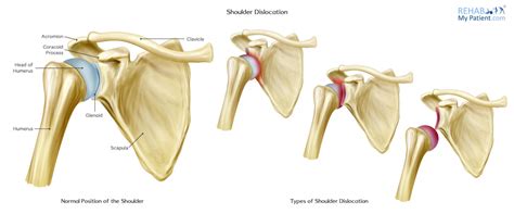 Shoulder Dislocation Types