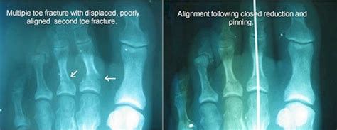Broken Toes Causes And Treatment Options