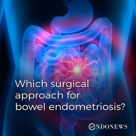 Symptoms may include abdominal pain, heavy periods, and. Which surgical approach for bowel endometriosis? | EndoNews