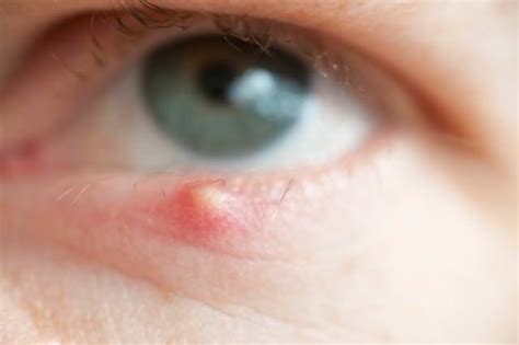 Sebaceous Cyst Eyelid Treatment
