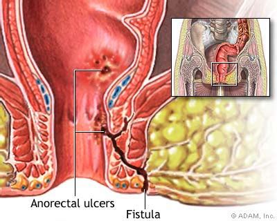 The New York Times Health Image Anorectal Fistulas