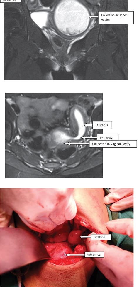 Figure 3 From Uterine Didelphys With Transverse Vaginal Septum A