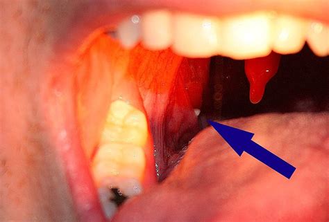 Tonsil Stones Cause Bad Breath Profresh Uk