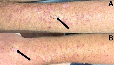Can Statins Cause A Skin Rash Better Health Channel
