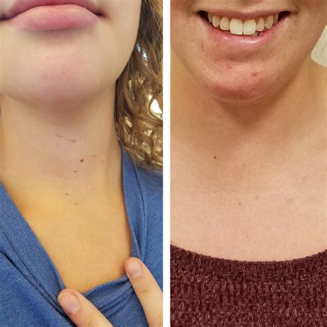 Completely Scarless Thyroidectomies
