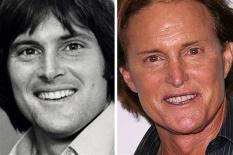 Bruce Jenner Bad Plastic Surgery Awards Pictures