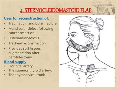 Local And Regional Flaps In Head And Neck Reconstruction