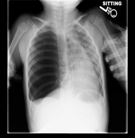 Nov 16, 2020 · a pneumothorax is defined as a collection of air outside the lung but within the pleural cavity. X- Ray Diagnostics Of Pneumothorax: Radiographic ...