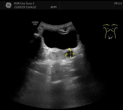 Sonography Of The Abdomen Showing A Cystic Lesion 13 Cm In Size Download Scientific Diagram