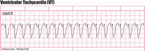 Ventricular Tachycardia Causes Symptoms Diagnosis Prognosis And Treatment