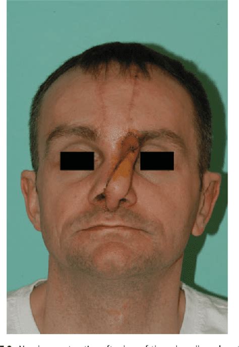 Figure 1 1 From Nasal Reconstruction With The Paramedian Forehead Flap