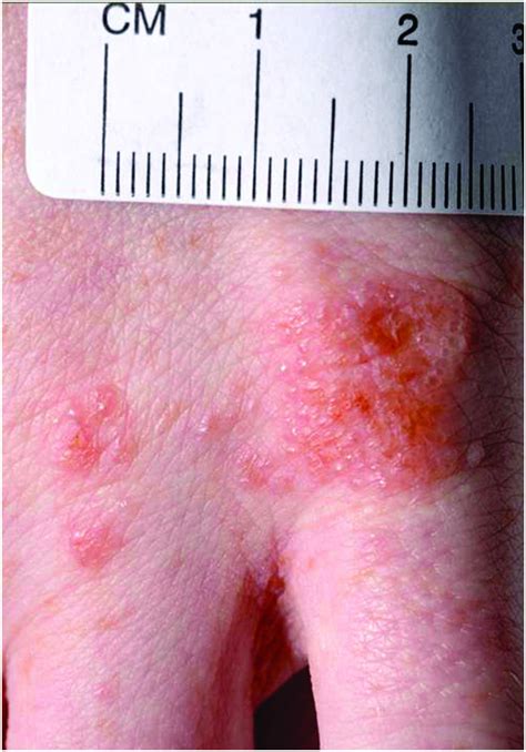 Spongiotic Dermatitis With Eosinophils Pregnancy Informations