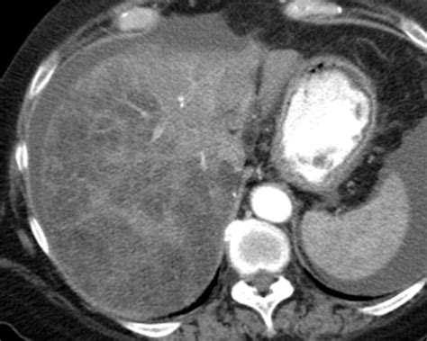 Liver Atlas Diagnosis Steatosis Steatohepatitis