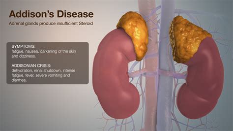 Addisons Disease Explained Using Medical Animation