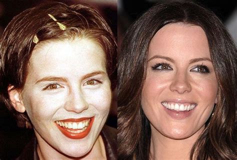 Kate Beckinsale Plastic Surgery Done Right