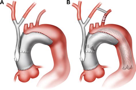 Results With An Algorithmic Approach To Hybrid Repair Of The Aortic