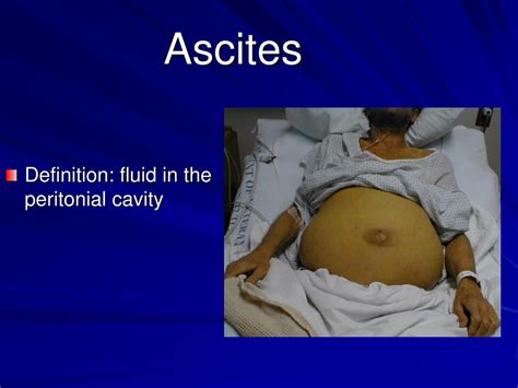 Ppt Complications Of Liver Cirrhosis Powerpoint Presentation Id183589