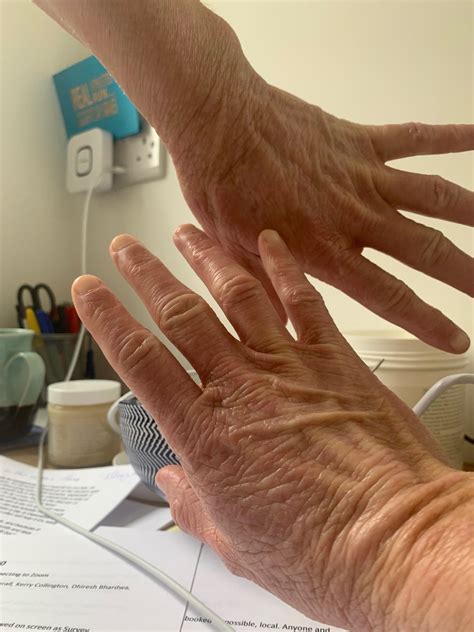 Can Gel Gloves Help Heal Hand Eczema What Allergy Blog