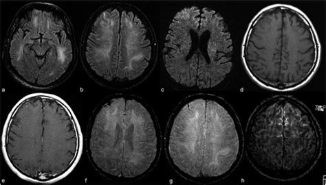 Mri Shows Brain Abnormalities In Some Covid 19 Patients