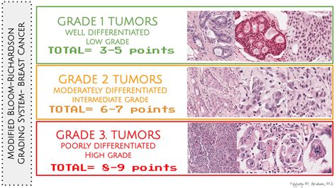 Grading Breast Cancer Modified Bloom Richardso Grading Made Simple