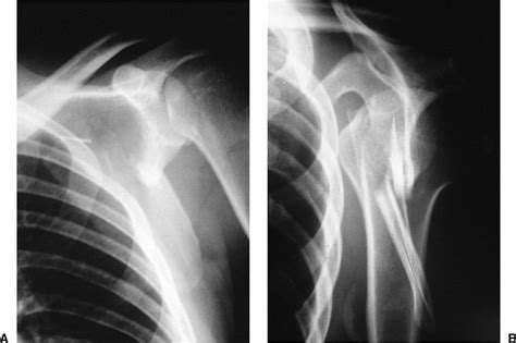 Scapula Fractures | Musculoskeletal Key