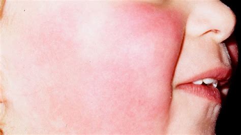 Fifth Disease Erythema Infectiosum Cause Symptoms Diagnosis And Treatment