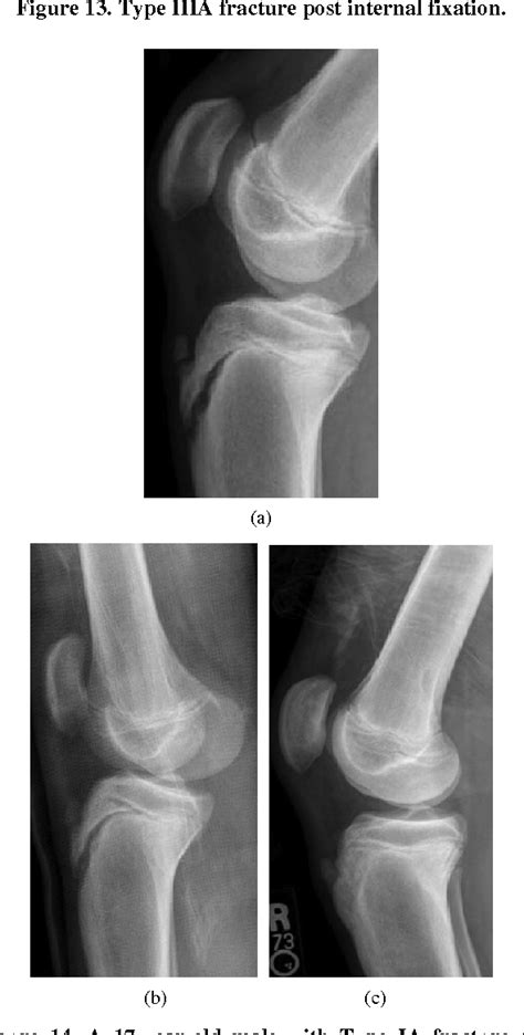 Pdf Imaging Review Of Adolescent Tibial Tuberosity Fractures