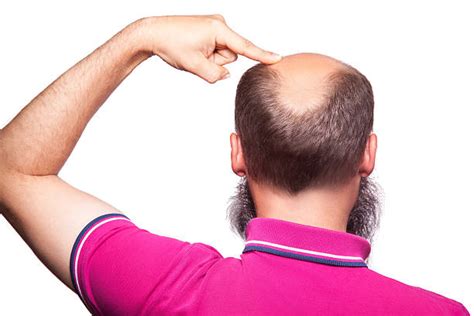 Royalty Free Bald Head Back Pictures Images And Stock Photos Istock