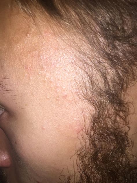 What Are These Bumps Please Help General Acne Discussion