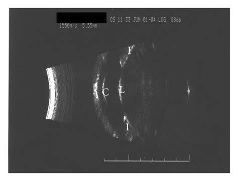 Ultrasound Biomicroscopy Image Of The Right Eye A And The Left Eye