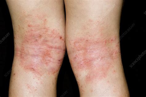 Atopic Eczema On Back Of Knees Stock Image C0083614 Science