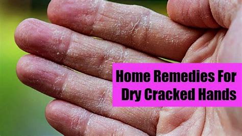 Home Remedy For Roughcracked And Dry Hands I Winter Skin Care Tips Youtube