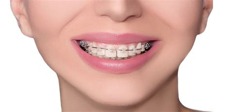 They include brackets that are attached to the front of your teeth or bands. The Pros & Cons of Six Month Smiles | Total Orthodontics