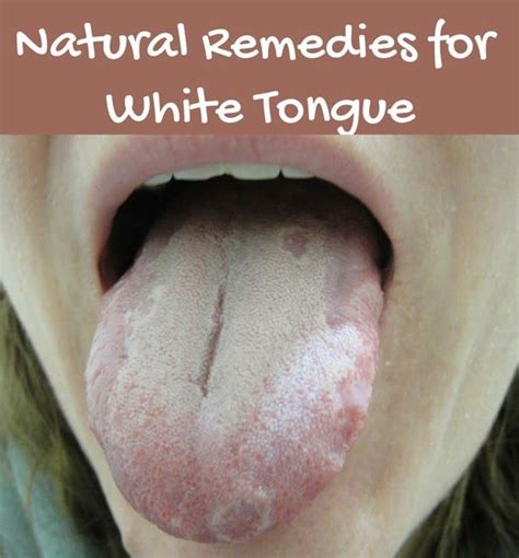 Natural Remedies For White Tongue Pin Remedies Natural Remedies