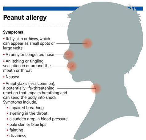 Deeper Look Into Nut Allergies With Images Peanut Allergy Symptoms