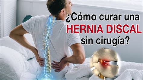 ¿cómo Curar Una Hernia Discal Lumbar Sin Cirugía Tratamiento Efectivo