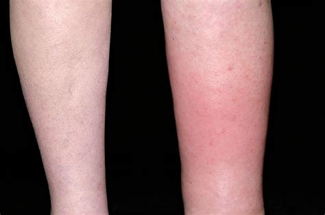 Cellulitis And Lymphoedema Of The Leg Photograph By Dr P Marazzi