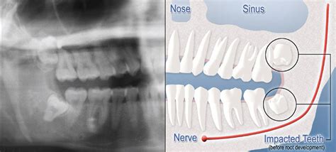 Impacted Wisdom Teeth Upper Marlboro Md Third Molars Impacted Tooth