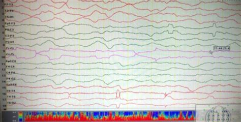 Eeg Of The Case Showing Severe Diffuse Encephalopathy Download