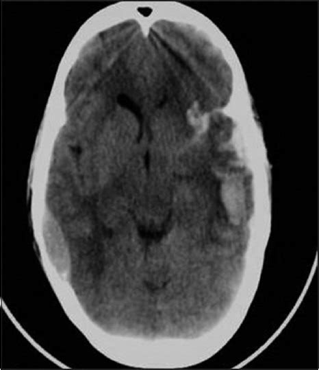 Non Contrast Computerized Tomography Of The Brain Showing Epidural