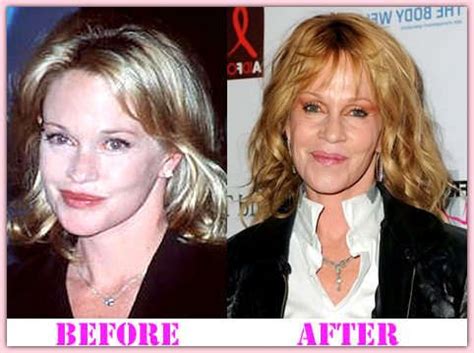 Melanie Griffith Plastic Surgery Before And After
