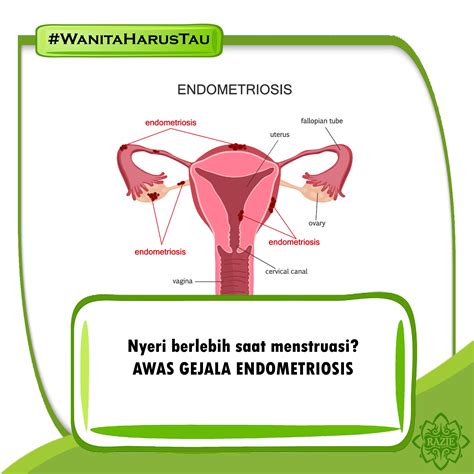 Endometriosis Merupakan Penyakit Yang Diakibatkan Pertumbuhan Jaringan