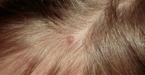 Heres How To Treat Pimples On Scalp Home Remedies Causes And Prevention