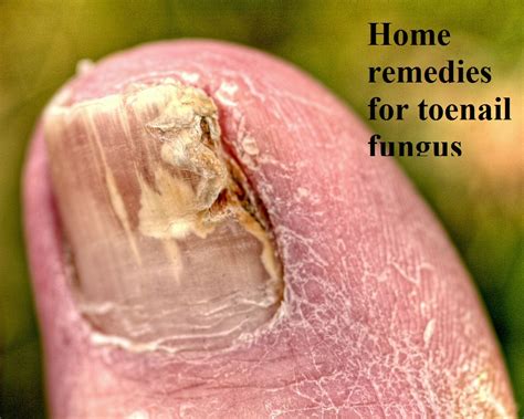 Best Over The Counter Toenail Fungus Treatment Natural Remedies For