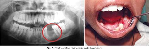 Figure 3 From Dentigerous Cyst Associated With Horizontally Impacted