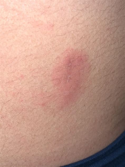 Showed Up On My Stomach Early Last Week It Started Out As One Diagonal