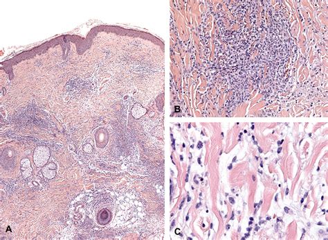 Palisaded Neutrophilic And Granulomatous Dermatitis Associated With